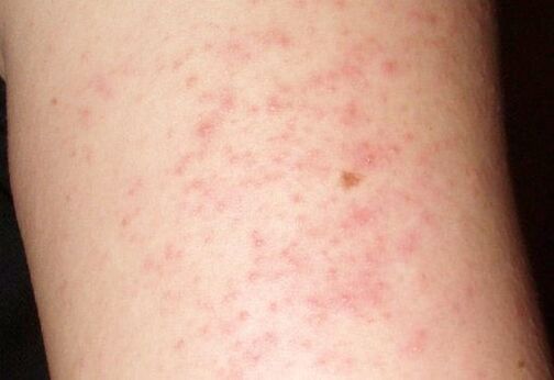 Itchy Rashes - A Symptoms of Liver Worms
